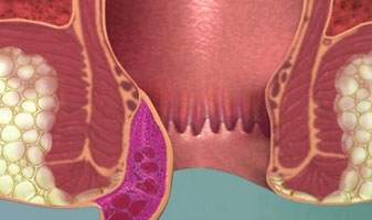 Piles (Hemorrhoids)