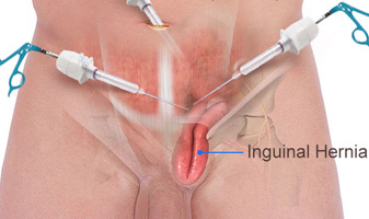 Hernia